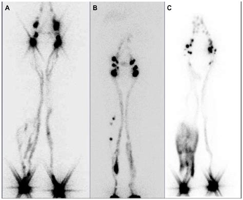 Belnuc | Methodological protocol for lymphoscintigraphy in limb edema ...