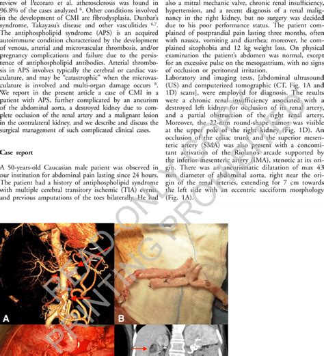 A Preoperative Ct Angiography Showing The Multivascular Alterations