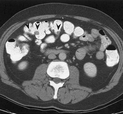 Differential Diagnosis Of Polypoid Lesions Seen At Ct Colonography