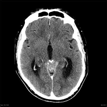 Pineoblastoma | Image | Radiopaedia.org