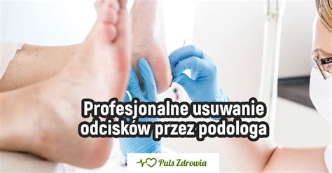 Profesjonalne usuwanie odcisków przez podologa Puls Zdrowia