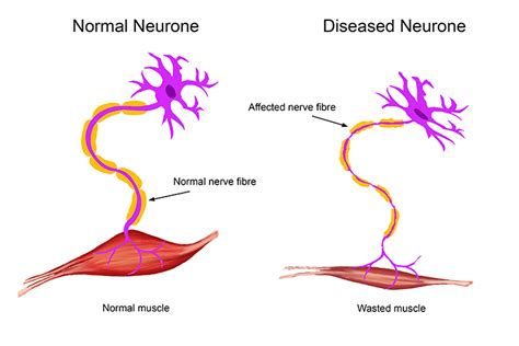 Motor Neurone Disease Is The Breakdown Of Nerve Cells