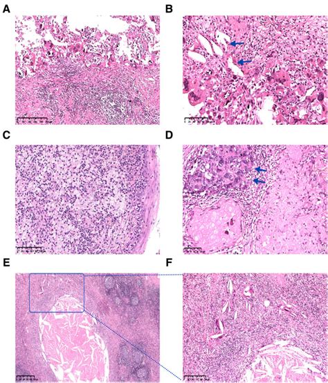 Significant Tumor Response Was Observed In The Radical Specimens A And