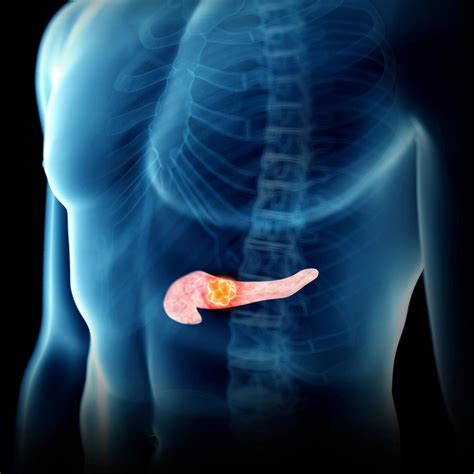 Revolutionizing Pancreatic Cancer Treatment With Personalized mRNA Vaccines