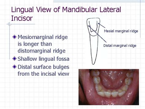 Permanent Anterior Teeth Incisors Chapter Central Incisor