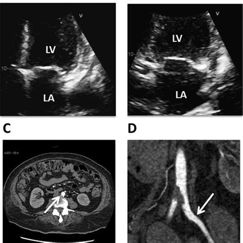 Contrast Enhanced Computed Tomography Of Saddle Embolus Distal Download Scientific Diagram