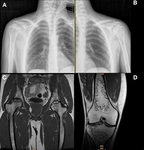 Caso clínico de osteonecrosis multifocal en paciente con leucemia