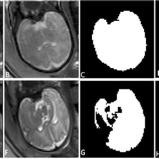 Pdf Comparison The Accuracy Of Fetal Brain Extraction From T Half