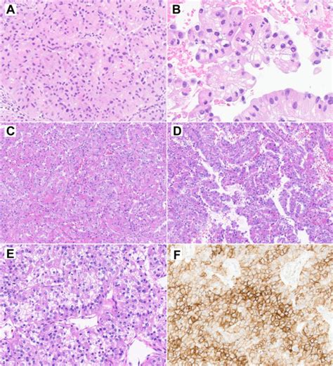 Molecular Characterization Of Tfe Rearranged Renal Cell Carcinoma A