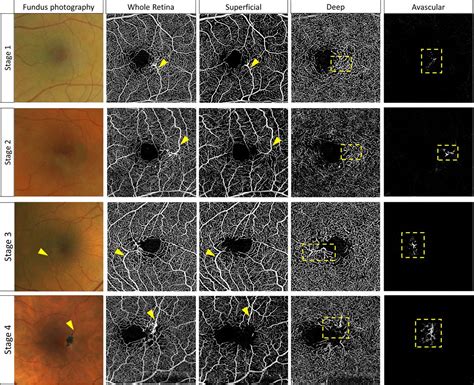 Right Angled Vessels In Macular Telangiectasia Type 2 British Journal