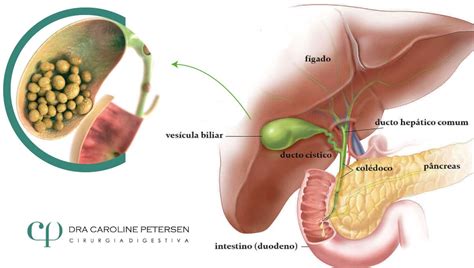 Cálculos biliares Guia abrangente para cirurgia e recuperação