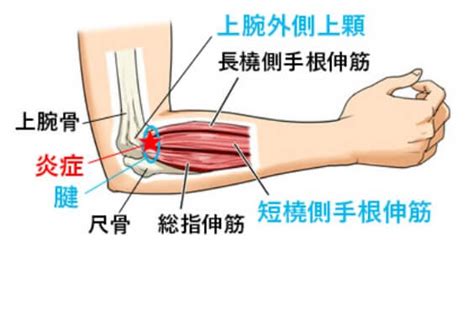 テニス肘｜指・手首・肘｜整形外科治療｜東京都渋谷区代官山｜drkakukoスポーツクリニック