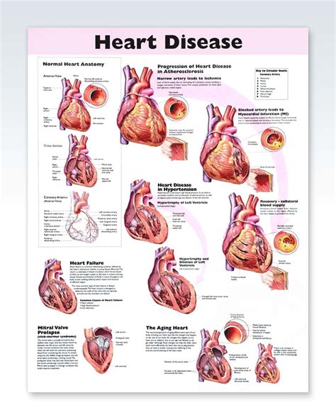 Heart Disease Exam Room Anatomy Poster Clinicalposters