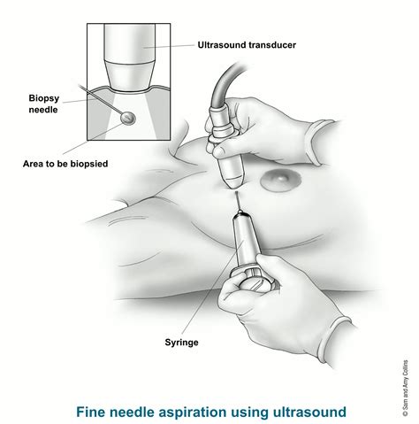 Fine Needle Aspiration Definition at Mark Cox blog