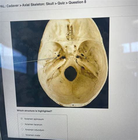 Solved Pal Cadaver Axial Skeleton Skull Quiz Question