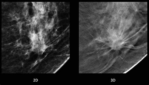 Digital Breast Tomosynthesis D Mammography Uf Health Jacksonville