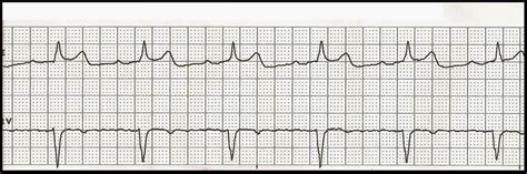 Various First Degree Heart Blocks