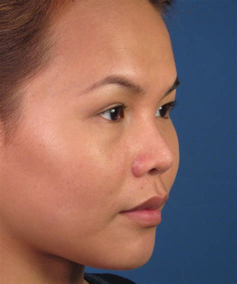 San Diego Asian Rhinoplasty Expert Dr John Hilinski Nose Reshaping