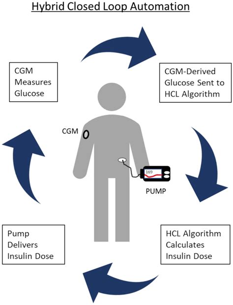 Illustration Of Hybrid Closed Loop System A Continuous Glucose Monitor