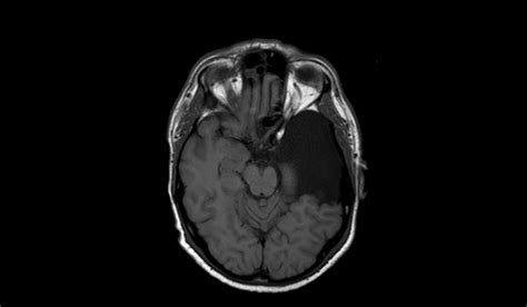 Arachnoid Cyst Mri Radiology Article On Arachnoid Cyst