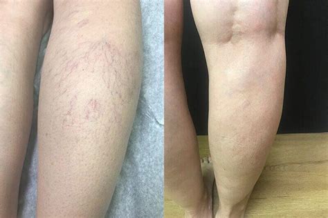 Before And After Sclerotherapy Procedures In Annapolis Md Dr O Donnell