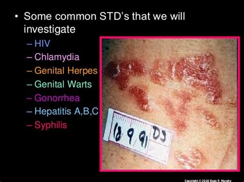 Hiv Aids Std S Sti S Human Immunodeficiency Virus Acquired Immu