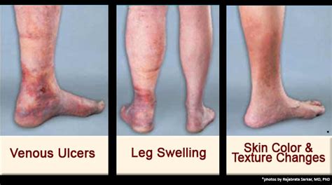 Arterial Vs Venous Disease