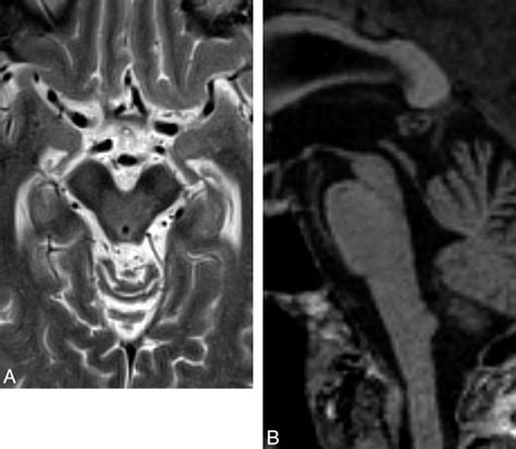 Axial T2 Weighted Mr Imaging Sequence In A Patient With Psp A Download Scientific Diagram