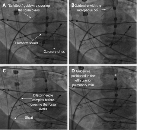 Sequence Of Fluoroscopy Imaging Of Transseptal Puncture In The Same