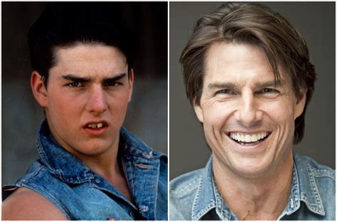 20 Fotos de famosos antes y después de usar brackets