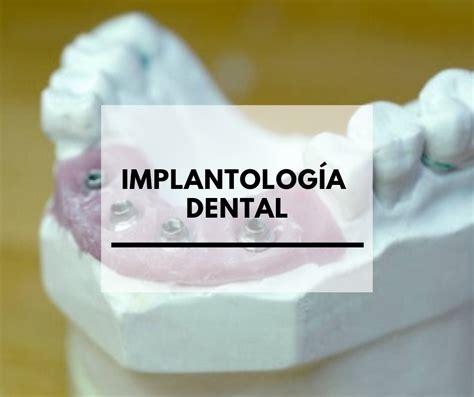 Beneficios De La Implantolog A Dental Centros Dentales Tus Dentistas