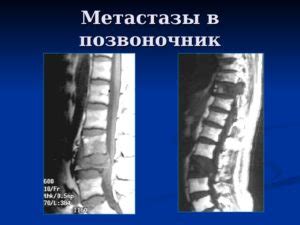 Метастазы в позвоночнике: симптомы, лечение и прогноз
