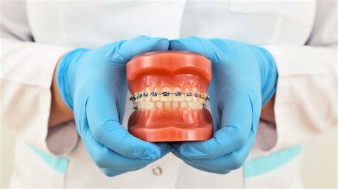 Cores De Borrachinha De Aparelho Saiba Como Cuidar Clinica Oraldents