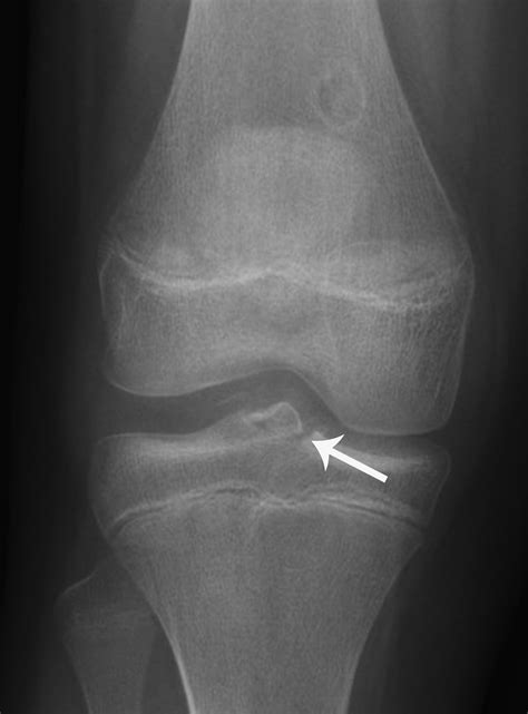 Radiographic Positioning Examples Of The Leg And Knee Ce Rt Off