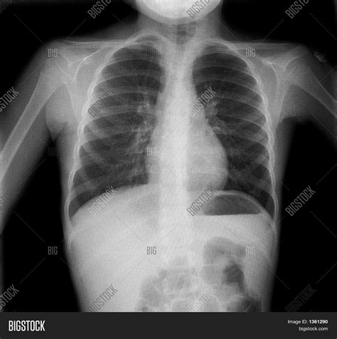 Plain Chest X Ray Image Photo Free Trial Bigstock