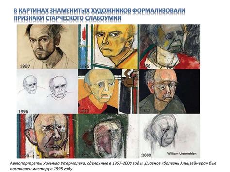 Деменция. Псевдодеменция. Современные представления об этиологии и ...