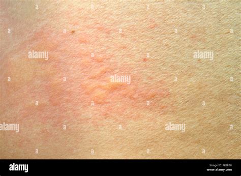 Urticaria Urticaria Fotografías E Imágenes De Alta Resolución Alamy