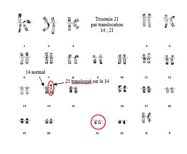 La Trisomie Trisomie Nouvelle Aquitaine