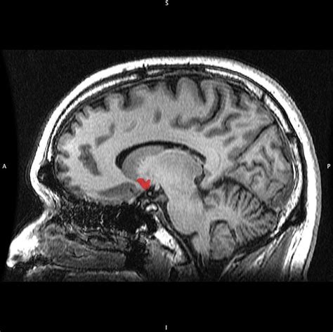 Sides of sentience: Pleasure centers (septal nuclei, nucleus accumbens ...