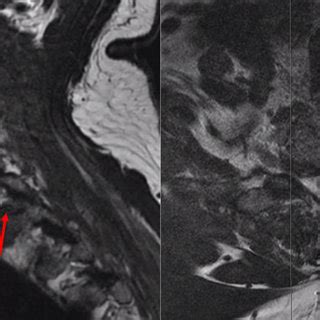 Sagittal And Axial Preoperative MRI T2 Weighted Sequences Showing A