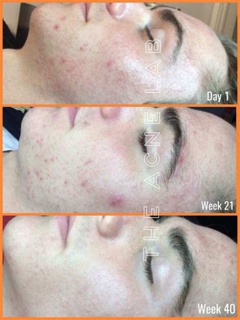 Combination Acne — The Acne Lab