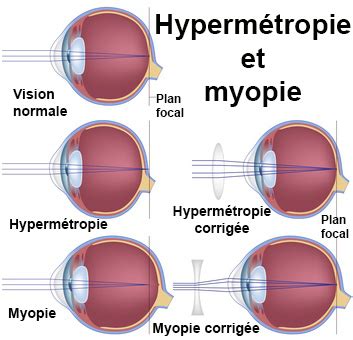 Hyperm Tropie Sympt Mes Traitement D Finition Docteurclic