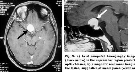 Figure 1 From Atypical Presentation Of Suprasellar Meningioma