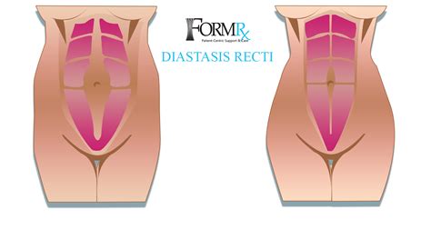 Obgyn Comfort Compression Garments Form Rx