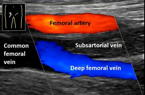 Diepe veneuze trombose - Deep vein thrombosis - other.wiki