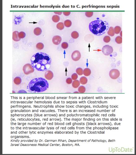 Hemolytic Anemia And Membrane Disorders Flashcards Quizlet