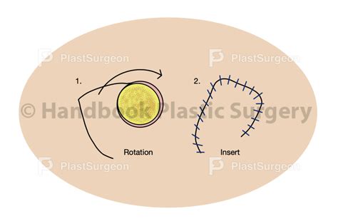 Design Plastsurgeon