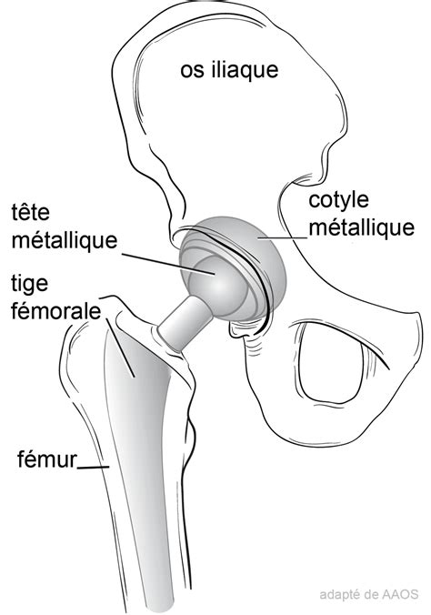 Hanche Dr Philippe LORIAUT Chirurgien Orthopédiste Paris