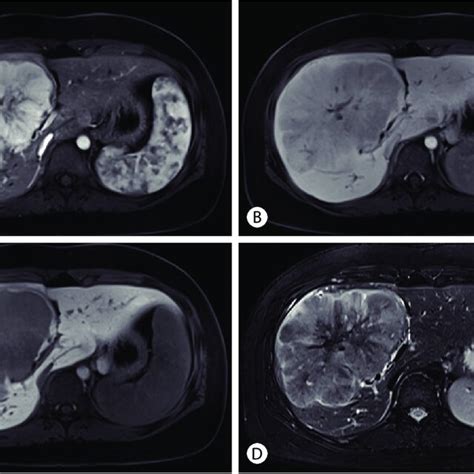 Liver Dynamic Magnetic Resonance Imaging Showed 13 Cm Sized Lobulated Download Scientific