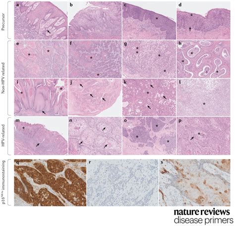 Nature Reviews Disease Primers On Twitter The Pathology Report For